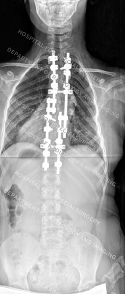 X-ray images of dystrophic scoliosis after surgery 