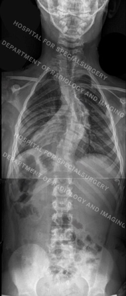 X-ray image of dystrophic scoliosis