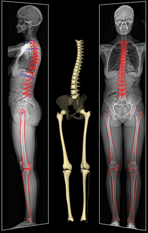 EOS full-body imaging of a patient with 2D low-dose X-ray and 3D rendering of the spine, hips and leg bones.