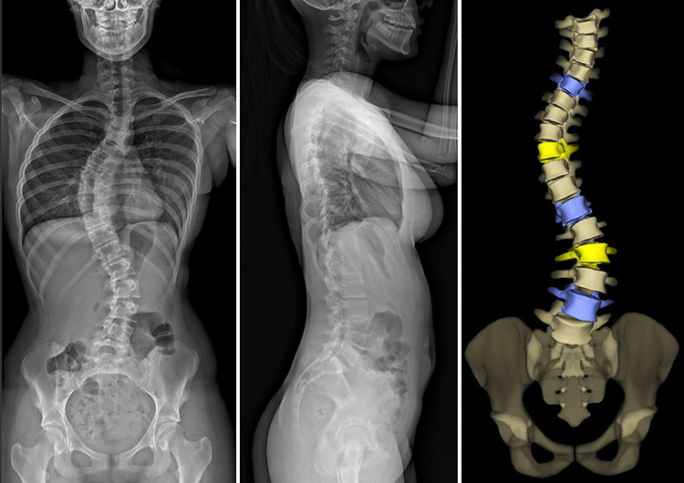 EOS imaging showing scoliosis of the spine.