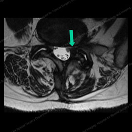 MRI of same patient after facet injection and cyst rupture
