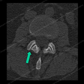 CT scan showing normal facet joints