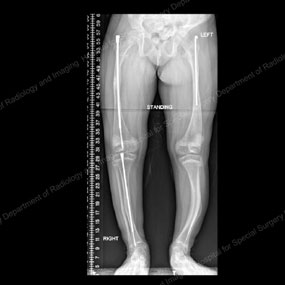 X-ray of a growing child with osteogenesis imperfecta with one intramedullary rod and one Fassier-Duval Rod.