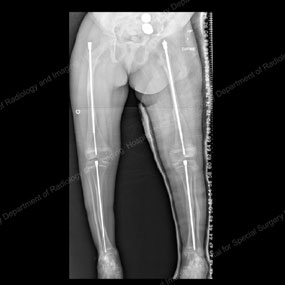 X-ray of a growing child with osteogenesis imperfecta treated with Fassier-Duval rods after outgrowing intramedullary rods.
