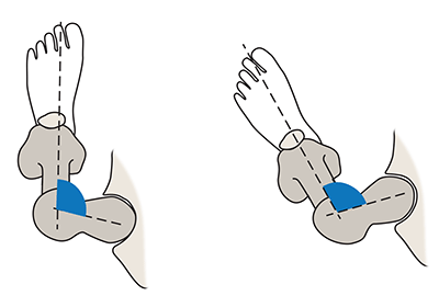 Illustration of femoral retroversion from a top view.