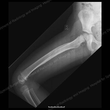X-ray image showing femur fracture 10 months after injury and removal of spica cast.