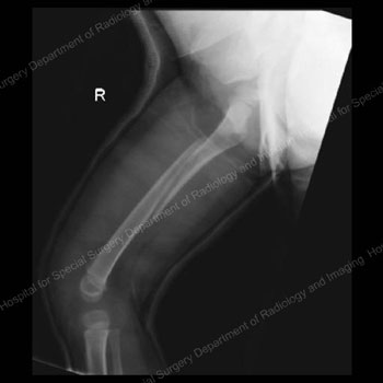 X-ray image showing femur fracture with spica cast.