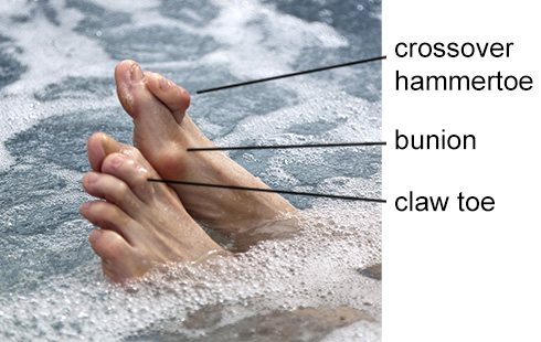 Image of a person's feet showing hammertoe, claw toe and bunion conditions.