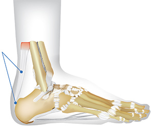 Illustration of Achilles tendon pain locations.