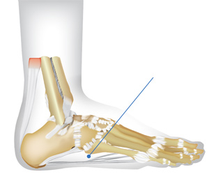 Drawing showing location of foot arch pain.