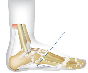 Pain in front bottom of foot on sale