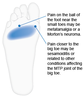 Illustration of the ball of the foot with location for metarsalgia, Morton's neuroma between the third and fourth toe, and sesamoiditis at the base of the big toe.