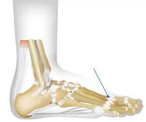 Illustration showing location of  (first metatarsophalengeal joint (base of big toe) pain.