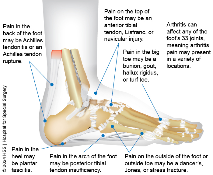 Foot pain chart showing conditions by location of pain in the foot.