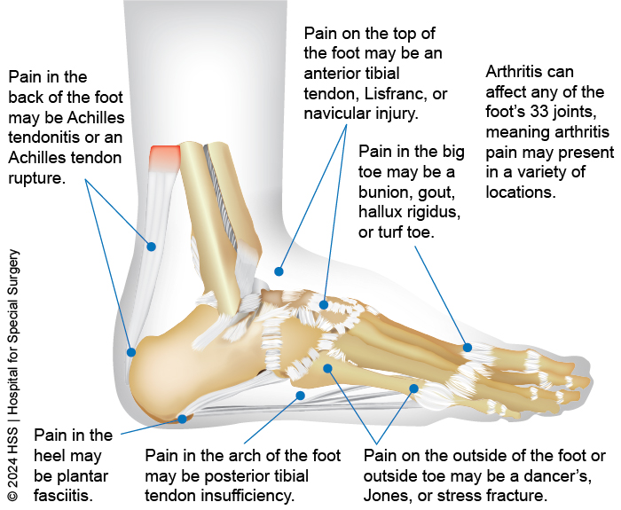 Foot and Ankle Pain Causes and Treatment - Beacon Law