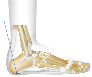 Drawing showing location of heel pain.