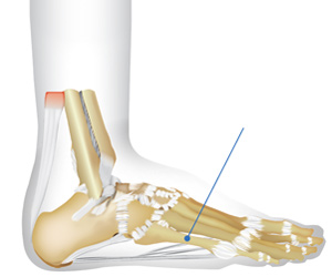Lateral (outside) aspect of the foot.