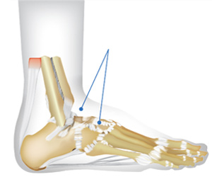 Illustration showing location of doral (top) foot pain.