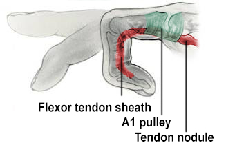 Illustration of trigger finger with a nodule on the flexor tendon.