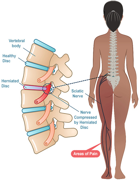Illustration of a herniated disc compressing the sciatic nerve.