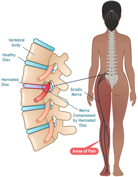 Lumbar Disc Herniation: Frequently Asked Questions