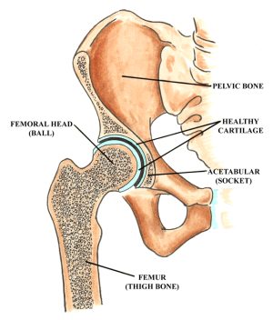 Diagram of the hip joint noting the location of the Pelvic Bone, Healthy Cartilage, Acetabular (socket), Femur (thigh bone) and Femoral Head (ball)
