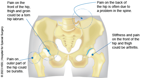 Hip Pain Location Diagram