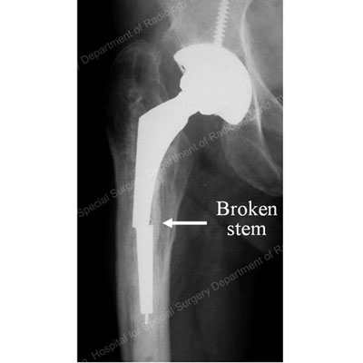 X-ray image showing broken stem section of a total hip replacement prosthesis.