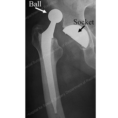 X-ray image showing dislocated total hip replacement prosthesis.