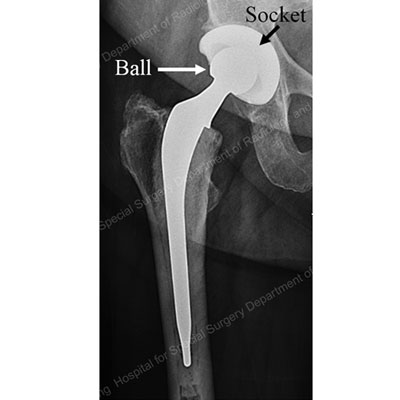 X-ray image showing prosthesis for total hip replacement.