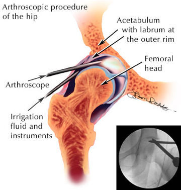 An illustration of the locations for the incisions and instruments during hip arthroscopy from an article about Femoroacetabular Impingement
