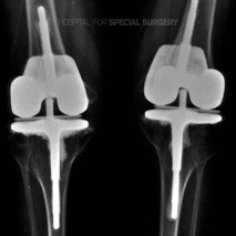Post-op X-ray of patient who has undergone arthroplasty of both knees