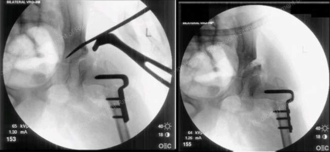 X-ray images obtained during a varus rotational osteotomy and a pelvic osteotomy.