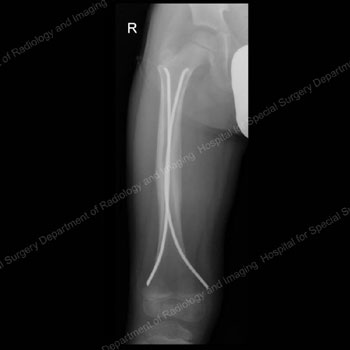 X-ray image showing flexible intramedullary nails in place.