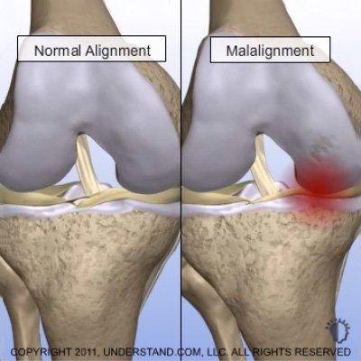 Image: Graphic showing knee misalignment.