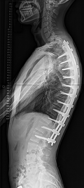 Lateral X-ray of a patient after complex spine surgery to correct a kyphosis condition.