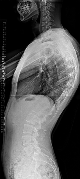 Lateral X-ray of a patient with kyphosis.