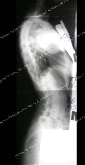 Side view resurgical X-ray for scoliosis requiring anterior approach.