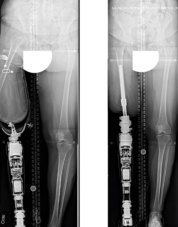 X-ray images: Before and after above-the-knee osseointegrated leg implant and prosthesis, with vastly improved alignment.