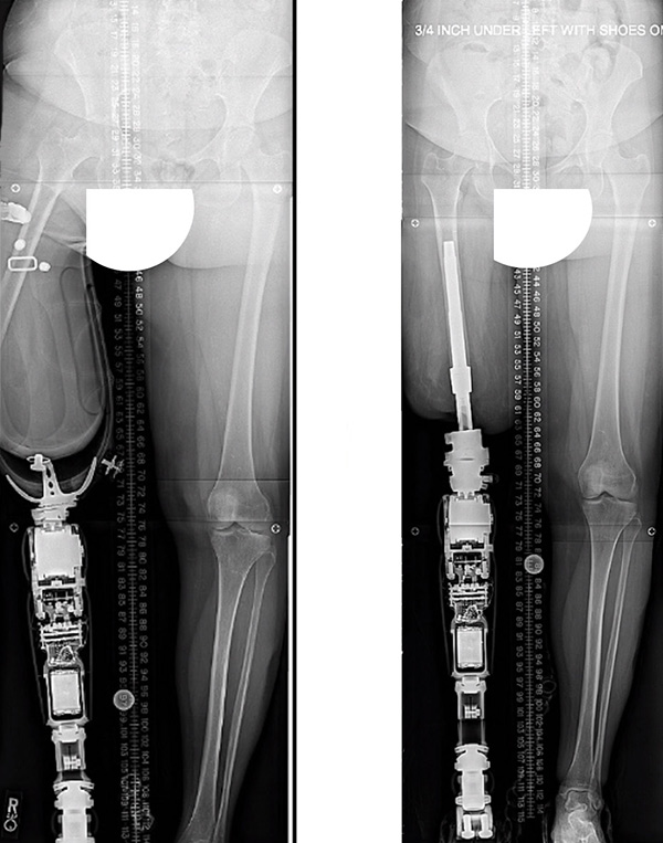 Osseointegration Limb Replacement: More Control for Amputees