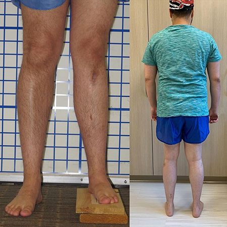 Photo of a patient before and after limb lengthening surgery, showing postoperative equal length legs.