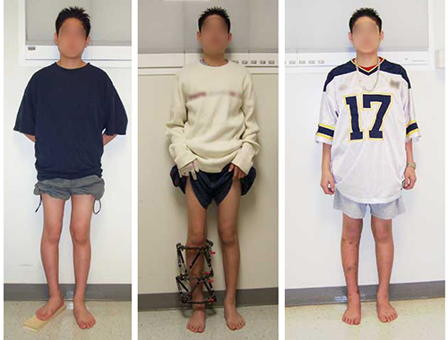 Images of a pediatric patient (1) before surgery with different lengh legs, (2) wearing an external fixator to lengthen the leg, and (3) after surgery, with equal length legs.