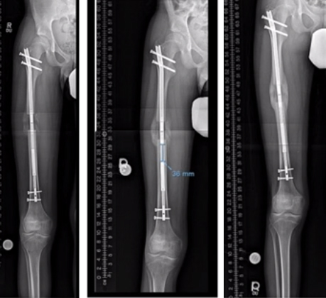 X-ray images of limb lengthening patient with internal nail lengthener at 5 weeks, 2 months and 3 months.