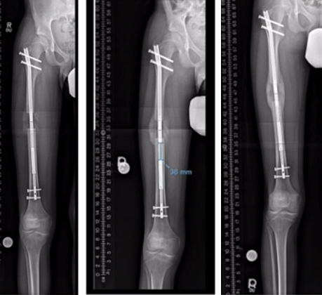 Bone Transport  International Center for Limb Lengthening