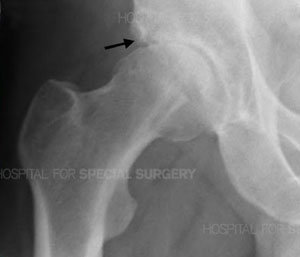 Anteroposterior radiograph of a hip with osteoarthritis