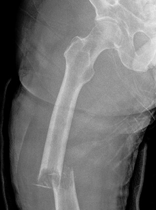 X-ray of a fracture due to metastatic bone lesion.