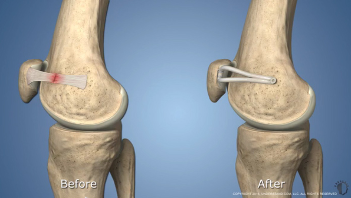 Medial Patellofemoral Ligament Mpfl Reconstruction Hss 2022