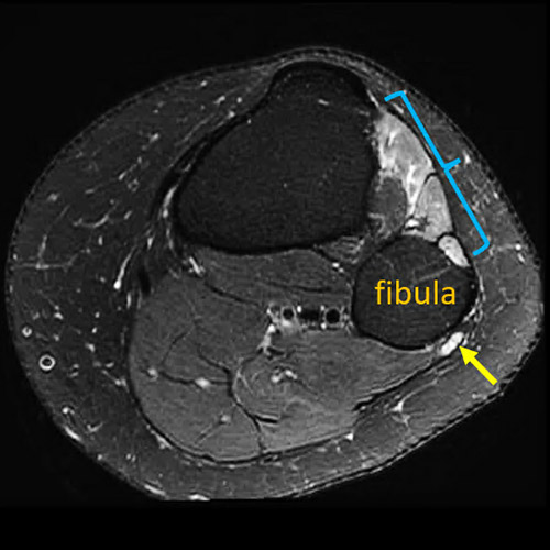 MR neurography image showing spontaneous foot drop at the fibula.
