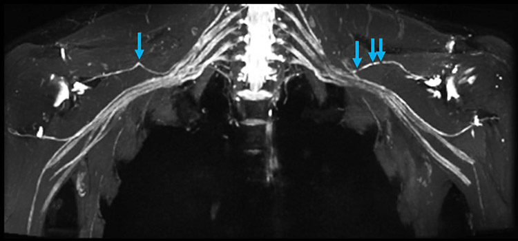 MR neurography of Parsonage-Turner syndrome with bilateral suprascapular nerve constriction.