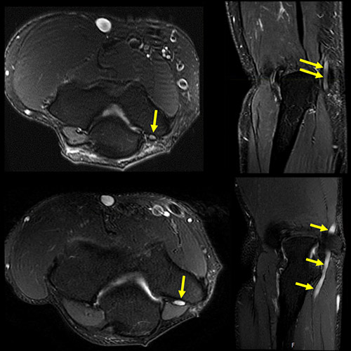 MR neurography imaging of cubital tunnel syndrome.